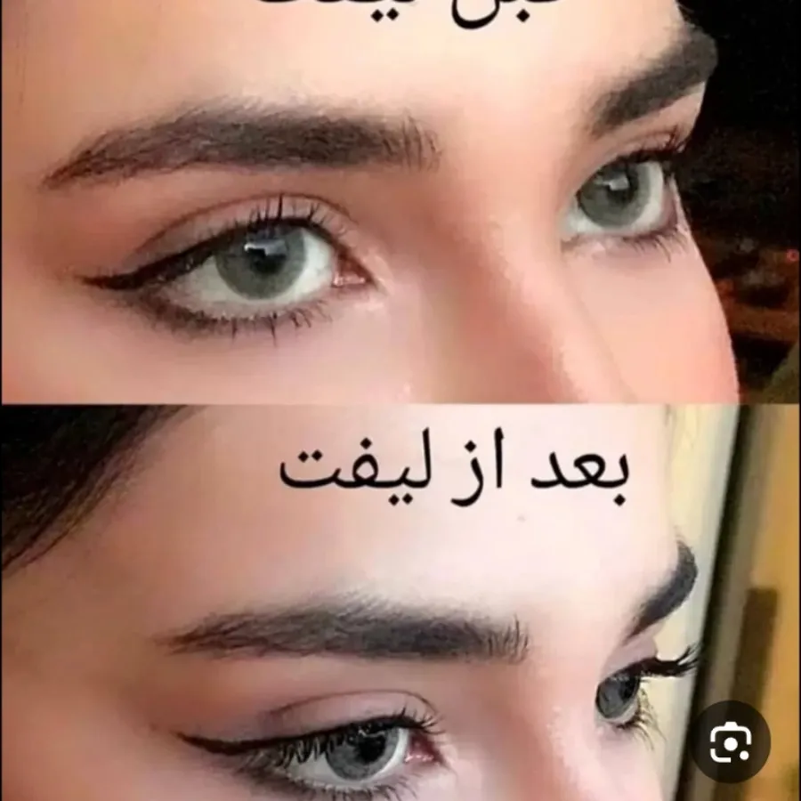 کش لیفت