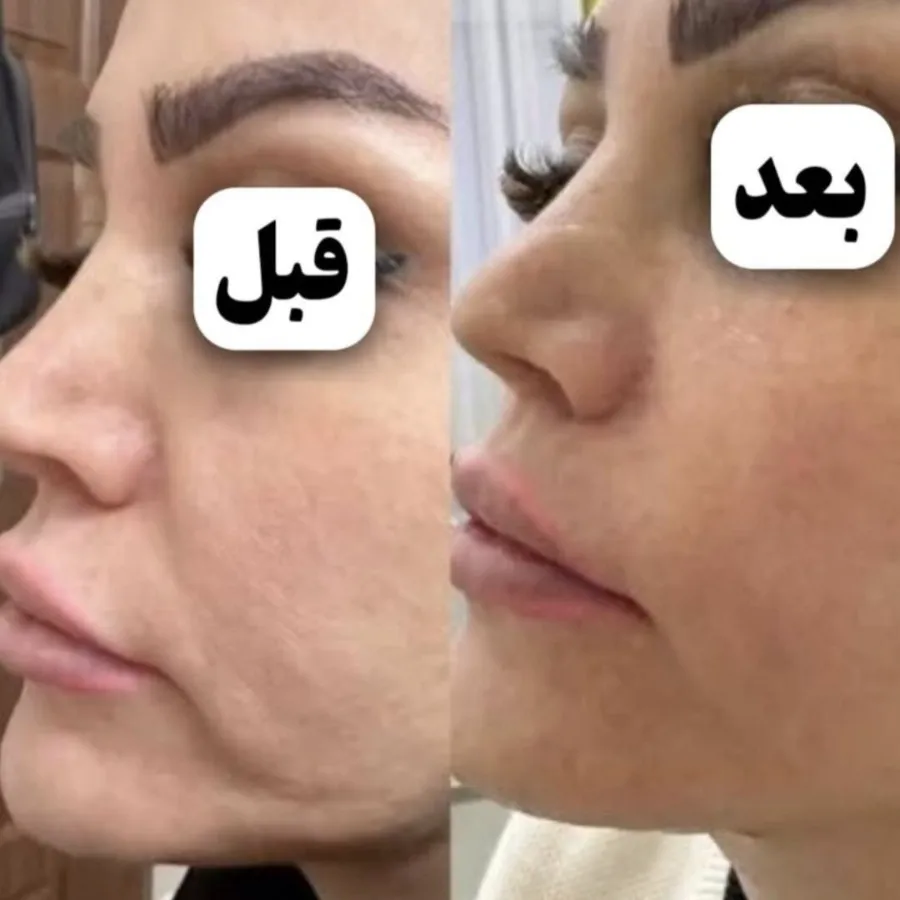 کرم بیوممتیک اسپانیایی